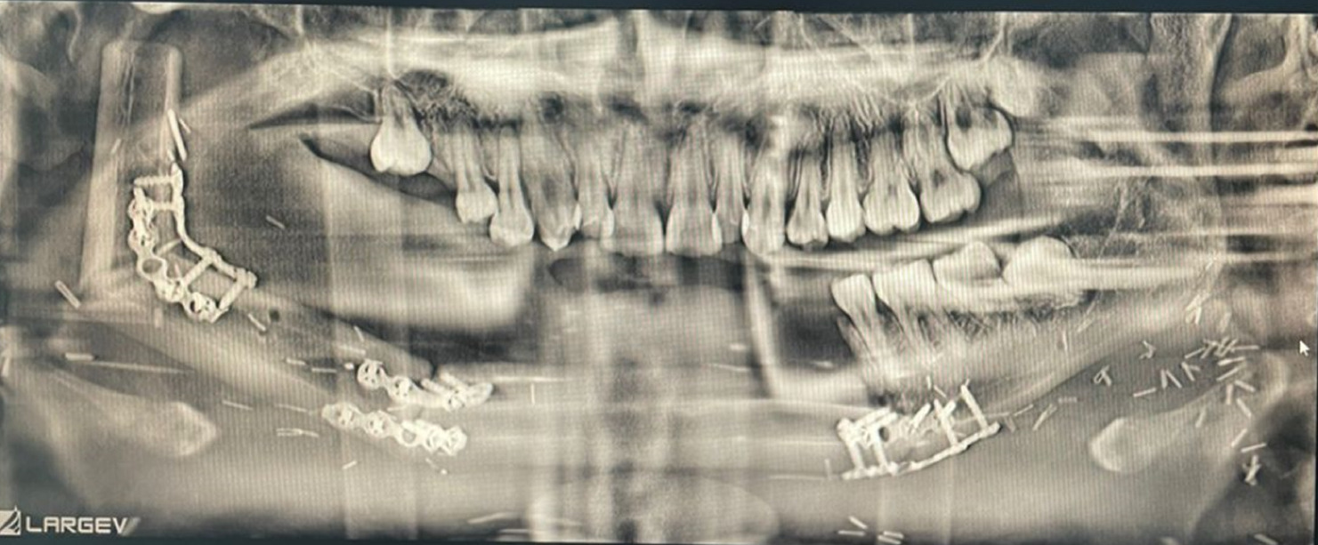 postSurgeryOrthopantomogram.jpg